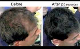 Receding Hair line, Frontal Hair Loss, Temple Hair Loss