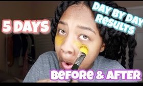 I USED TURMERIC & PINEAPPLE JUICE TO RECOVER  DARK CIRCLES IN 5 DAYS