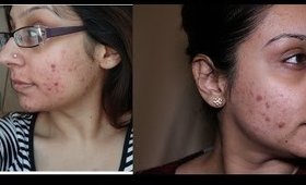 How to get acne cystic acne bacne | Makeup With Raji