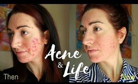 MY ACNE UPDATE 2017 // LIFE UPDATE // Jess Bunty