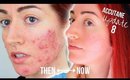 My Accutane Update 2018 (8 Months!) With Before & After | Jess Bunty