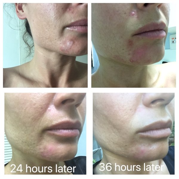 Toothpaste Burn On Face!! Help. Page 3 Beautylish