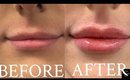 WATCH THIS BEFORE GETTING LIP FILLER!