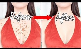 How To Get Rid Of BODY ACNE OVERNIGHT !!