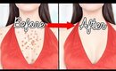 How To Get Rid Of BODY ACNE OVERNIGHT !!