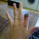 Severed finger!