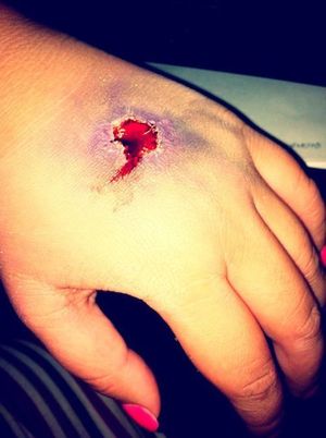 nail wound