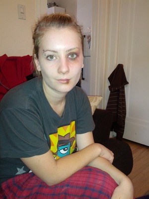 -scar putty under the eye and an injury pack to make it look like the eye was swollen.