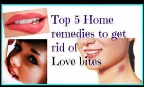 Tips-Top 5 Home remedies to get rid of Love bites