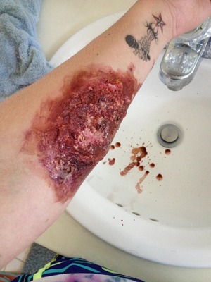 i created a chemical burn look on my arm for halloween ideas :)