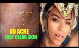 NO ACNE ONLY CLEAR SKIN LIKE BEYONCE IN "BLUE " #SKINCARESUNDAY