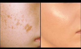 How To Get Clear GLOWING SKIN, Remove Acne Scars, Pimples │5 Indian Secrets for Spotless Skin Tone