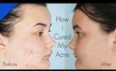 How I Cured My Acne: Curology 2 Month Results