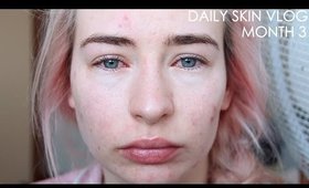 Roaccutane Daily Skin Vlog - Month 3