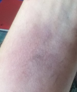 Bruise #1 
