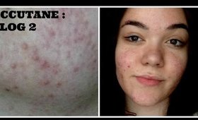 Accutane: Vlog 2 | My Treatment