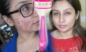 Clear Acne cystic acne by shaving | Raji Osahn