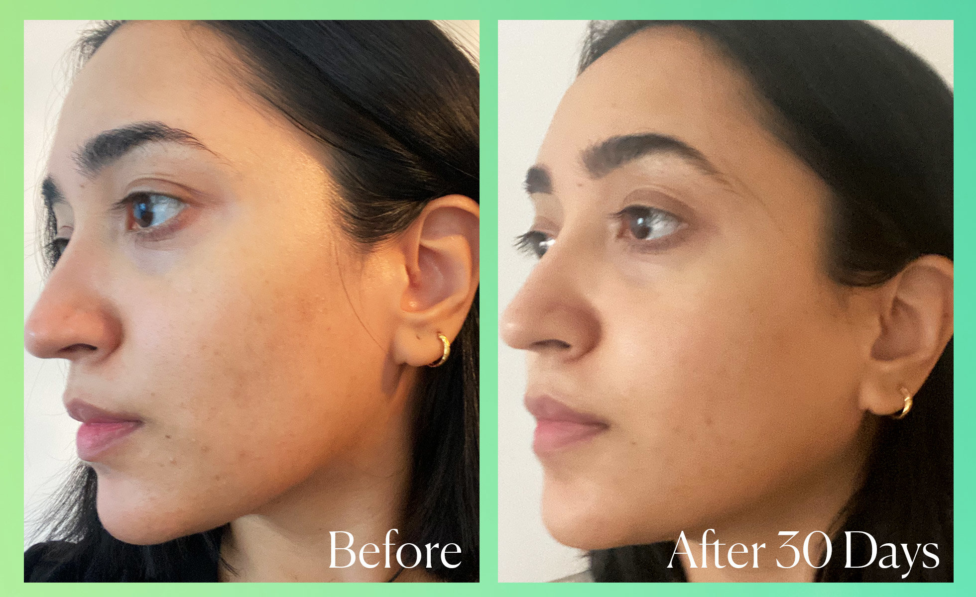 Nurain’s results after 30 days of using Good Molecules Discoloration Correcting Serum.
