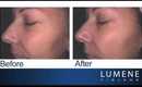 Dramatic Anti-Aging Results With Lumene