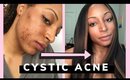 How I Cleared Cystic Adult Acne & Hyperpigmentation Fast