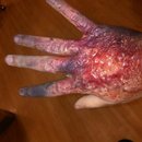Spfx Burnt Hand