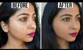 HOW TO COVER ACNE SCARS/BLEMISHES | EASY Foundation Routine | Stacey Castanha