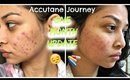 Accutane journey: One month update || Results & Side effects ||