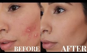 Acne Prone Skin Care Routine How to Get Rid of Breakouts