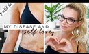 My Autoimmune Disease & How I Love My Skin | Motivation Monday