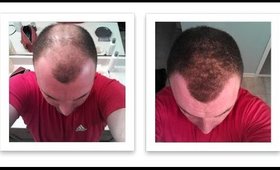 New Technology for Baldness and Thinning Hair