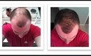 New Technology for Baldness and Thinning Hair