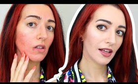 How To Cover Redness & ANNOYING PIMPLES With Makeup | Acne Scarring Coverage