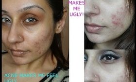 Acne makes me UGLY! Dealing with acne, teenage acne,adult acne,cystic acne || Raji Osahn