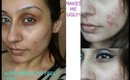 Acne makes me UGLY! Dealing with acne, teenage acne,adult acne,cystic acne || Raji Osahn