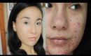 Acne Coverage  // Job Interview Makeup Tutorial