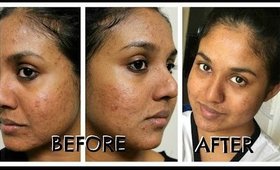 Acne Free Skin - All Natural Methods Part 2 (Skin Care, Acupuncture and much more)
