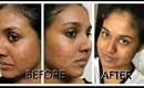 Acne Free Skin - All Natural Methods Part 1 (Skin Care, Diet and much more)