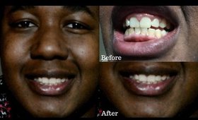 Teeth Whitening Routine with Smile Brilliant| #BeautyBasics