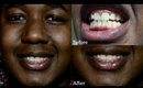 Teeth Whitening Routine with Smile Brilliant| #BeautyBasics