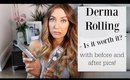 Derma Roller Review with Before and After Pics!