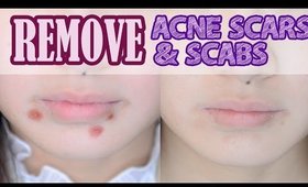 How to: Remove Acne Scars & Scabs