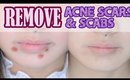 How to: Remove Acne Scars & Scabs