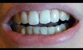 My teeth whitening journey at home: before! DIY