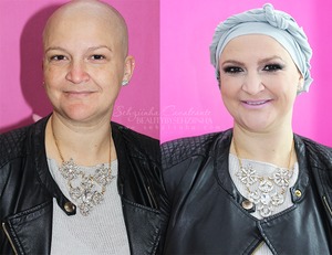 This is my pretty mother!
She had surgery this year to remove a tumor from the breast and is now having chemotherapy. And even without any hair for me has a unique beauty.
I love her so much <3