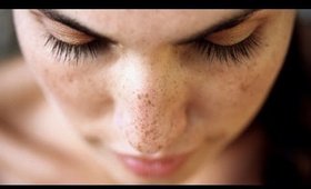 Lighten Acne Scars Naturally!