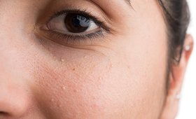 How To Treat Milia—the Tiny White Bumps on Your Face