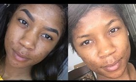 Banish Face Kit | How to Light Acne Scars | No Sob Story