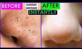 How To Remove Blackheads and whiteheads Instantly | SuperPrincessjo