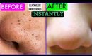 How To Remove Blackheads and whiteheads Instantly | SuperPrincessjo