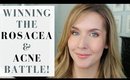 HOW I GOT RID OF ROSACEA AND ADULT ACNE | Products + Tips + Lifestyle Changes | My Story